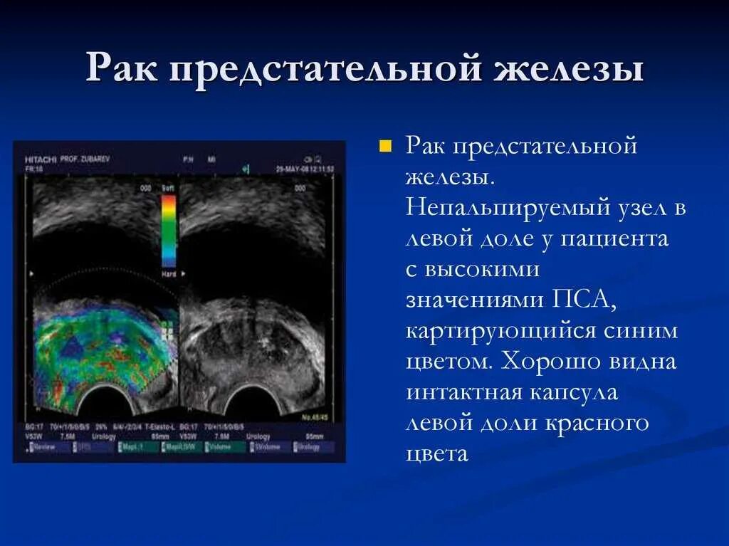 Онкология предстательной железы. Узлы в предстательной железе. Капсула предстательной железы. Образования в периферической зоне предстательной железы УЗИ.