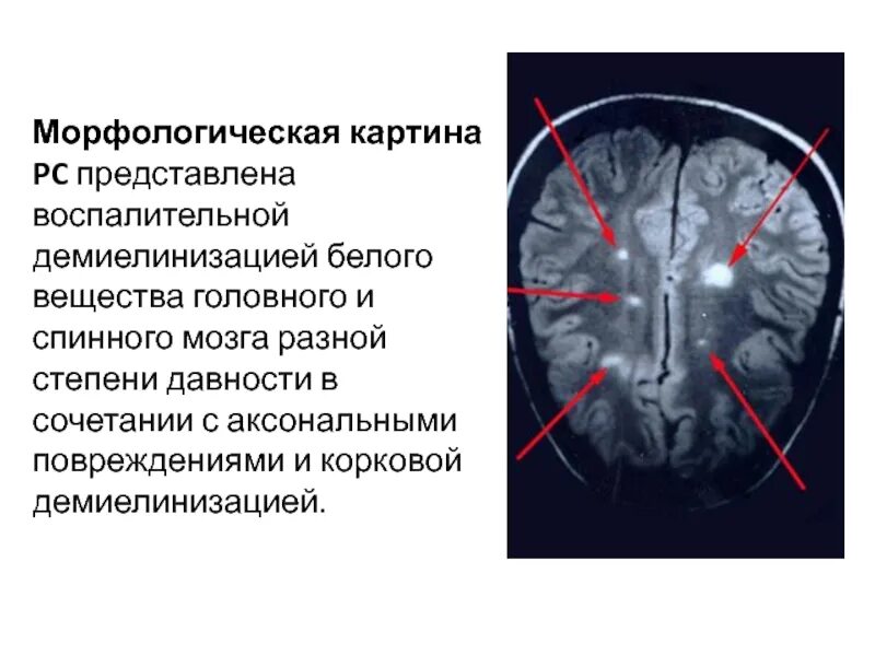 Склероз мозга. Демиелинизация спинного мозга. Очаги демиелинизации в спинном мозге. Очаги рассеянного склероза в спинном мозге. Очаги демиелинизации в спинном мозге мрт.