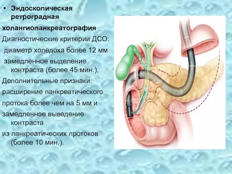 Стент желчного протока