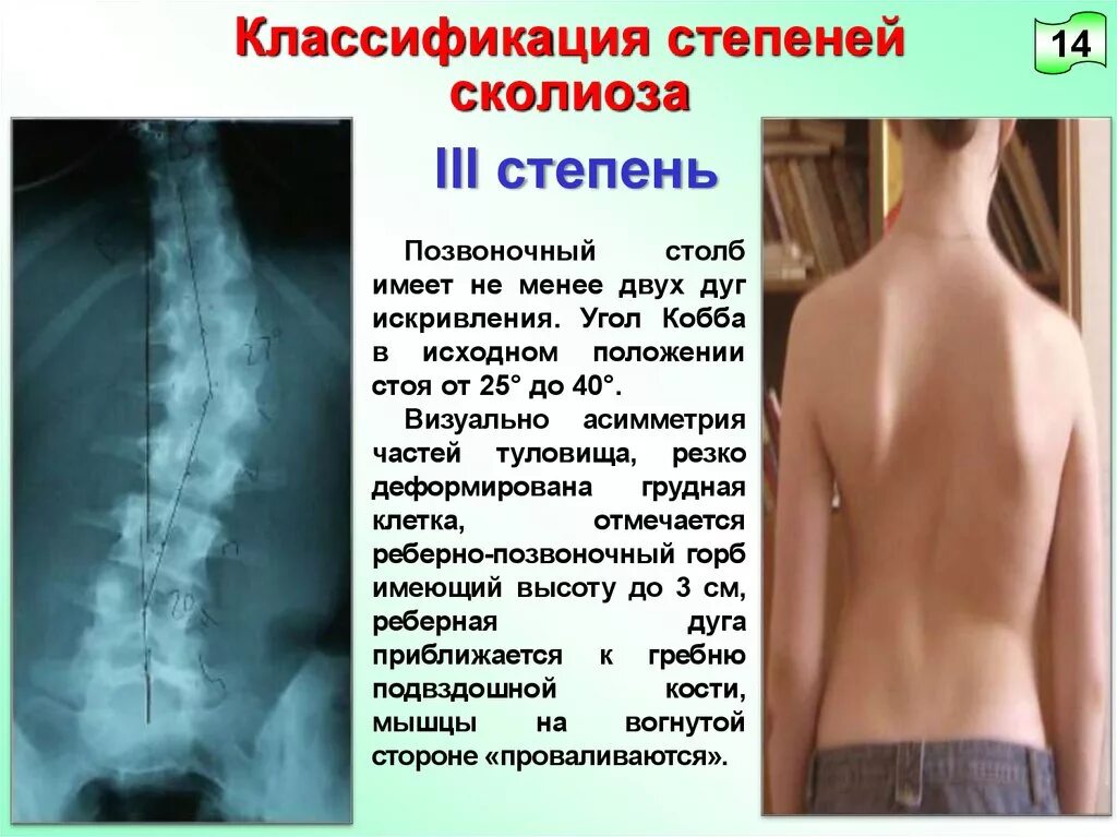 Сколиоз 2 степени это. Левосторонний сколиоз 3 степени. Сколиоз 2 степени угол искривления. Сколиоз 1 степени поясничного отдела рентген. Сколиоз 3 степени угол искривления.