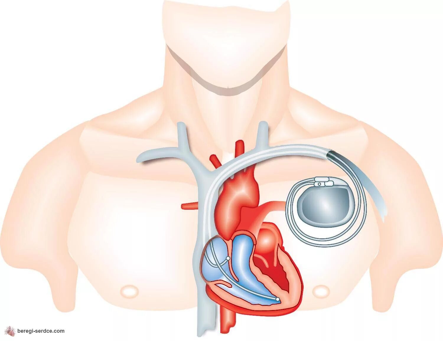 Сколько живут с кардиостимулятором. Кардиостимулятор Pacemaker. Имплантация сердца кардиостимулятор. Электрокардиостимулятор имплантируемый однокамерный.