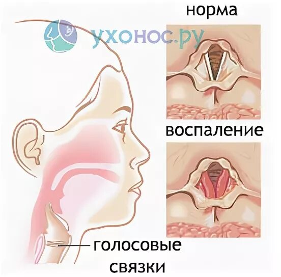 Как восстановить голосовые связки. Воспалились голосовые связки. Воспалённые голосовые связки. Голосовых связки ыоспооение. Воспаление гортани и голосовых связок.