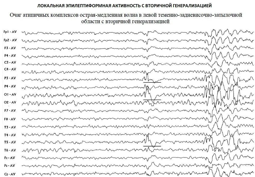 Что значит эпилептиформная активность. Эпилептиформные паттерны на ЭЭГ. Патологическая активность на ЭЭГ что это. Острые волны на ЭЭГ У взрослого. Полифазные волны на ЭЭГ.