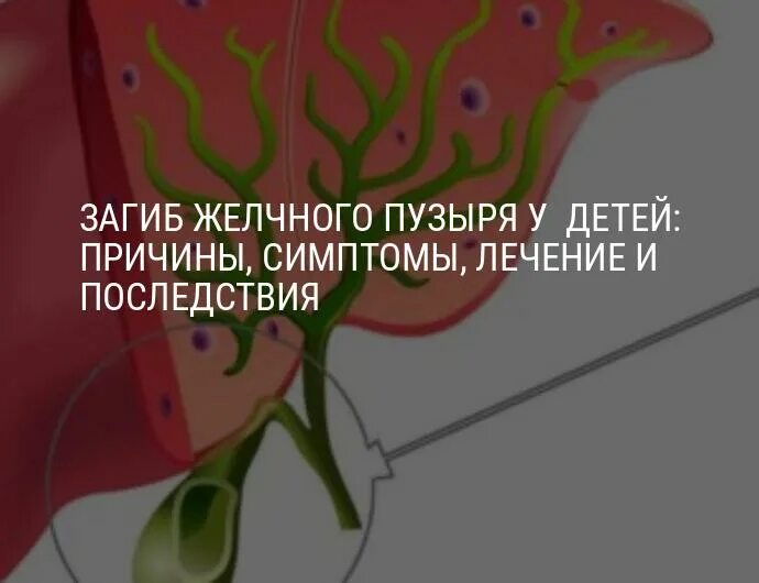 Загиб желчного пузыря что делать. Загиб желчного пузыря. Перегнутый желчный пузырь. Изогнутый желчный пузырь.