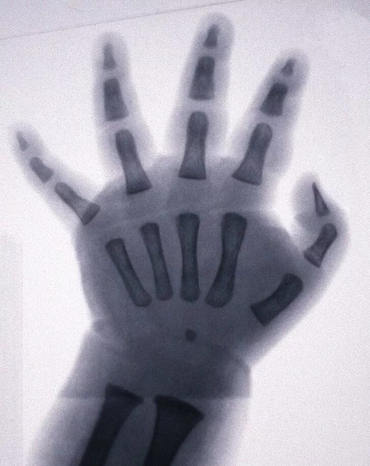 рентген кисти рук ребенка. рентген кисти рук ребенка. рентген кисти рук ребенка. рентген кисти рук ребенка. рентген кисти ребенка на костный возраст.