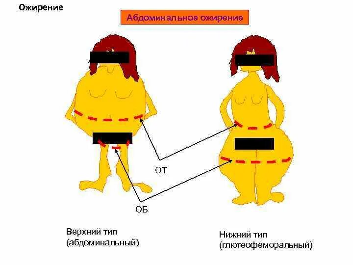 Абдоминальное одирени. Абдоминальный Тип ожирения. Абдоминальное ожирение. Ожирение типы ожирения.