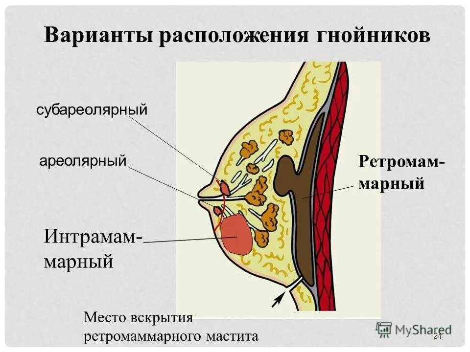 Лечение гнойного мастита. Субареолярный Гнойный мастит. Интрамаммарный Гнойный мастит. Лактационный и нелактационный мастит. Острый лактационный мастит.