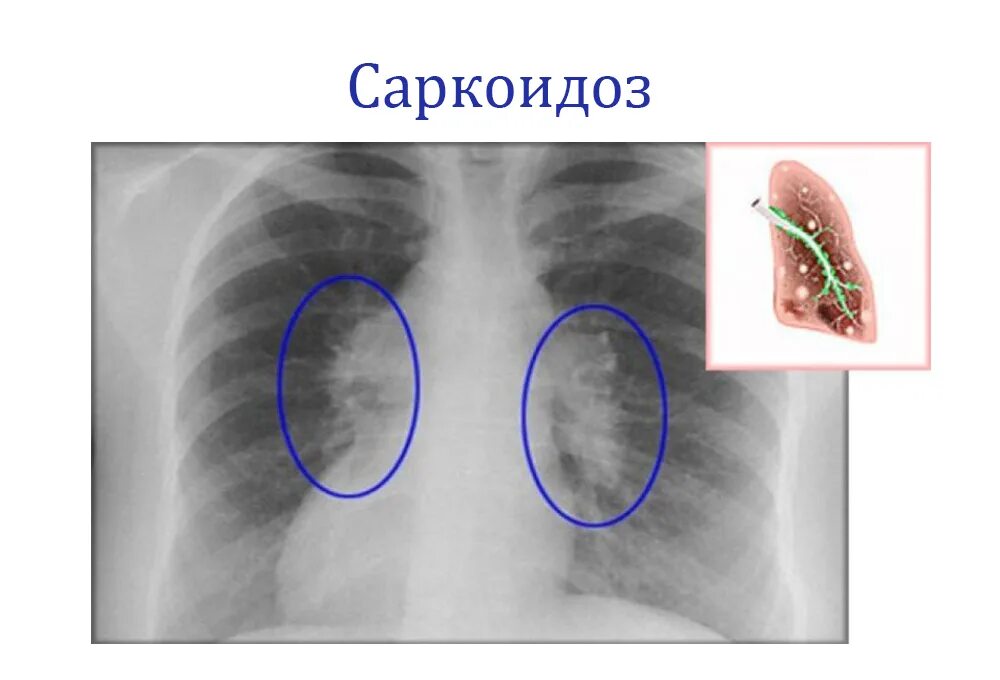 Саркоидоз 2 стадии рентген. Саркоидоз рентген грудной клетки. Кальцинаты в лимфоузлах