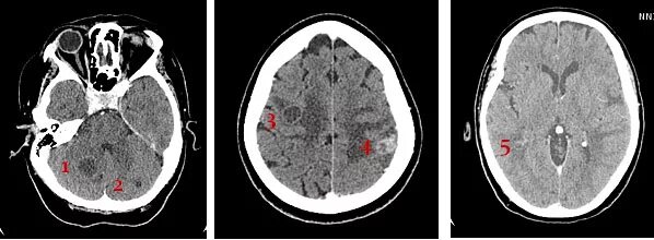 Метастазы в головном мозге на кт. Метастазы в головном мозге на кт. Пэт кт опухоли головного мозга. Метастазы опухолей головного мозга. Кт метастазы в мозг.