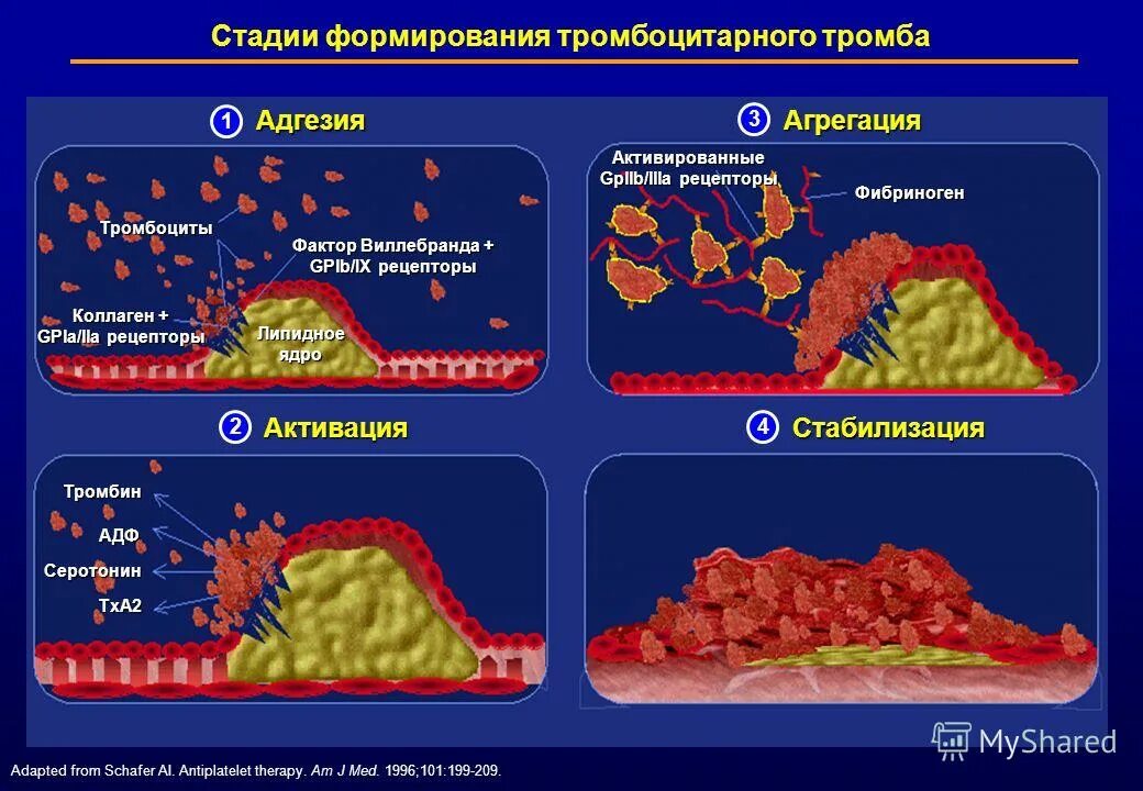 Стадии образования тромба схема. Этапы развития тромба. Этапы образования тромбоза. Стадии активации тромбоцитов.