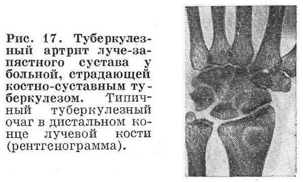 Туберкулез ноги. Туберкулез суставов рентген. Внелегочный туберкулез костей и суставов. Туберкулез костей стопы. Костно-суставного туберкулеза.