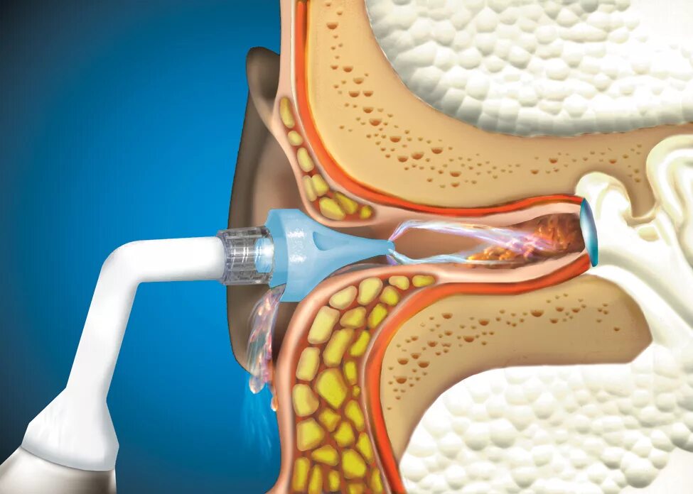 Промывание серной пробки. Серная пробка отоскопия. Промывание ушных пробок. Как промыть ухо водой