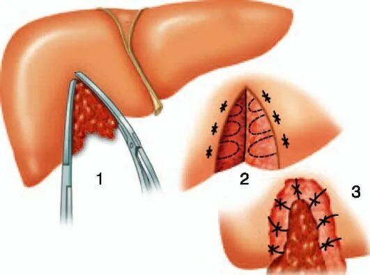 Liver damage concept. stock illustration. Illustration of page - 49221768