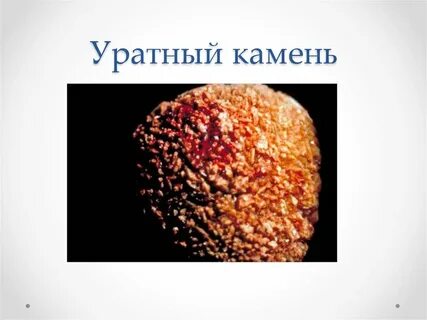 Виды конкрементов