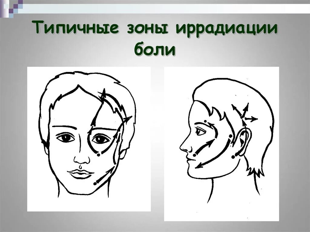 Иррадиация боли в нижнюю челюсть. Зоны иррадиации боли при пульпите. Иррадиация боли при пульпите зубов. Иррадиация зубной боли. Зоны иррадиации боли при пульпите по и.г Лукомскому.