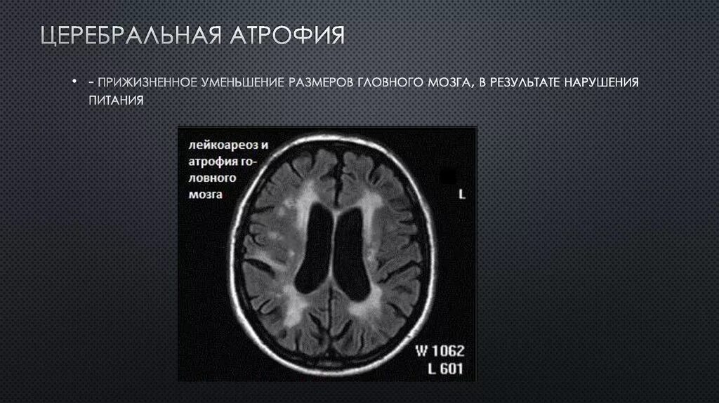 1 степень атрофии мозга