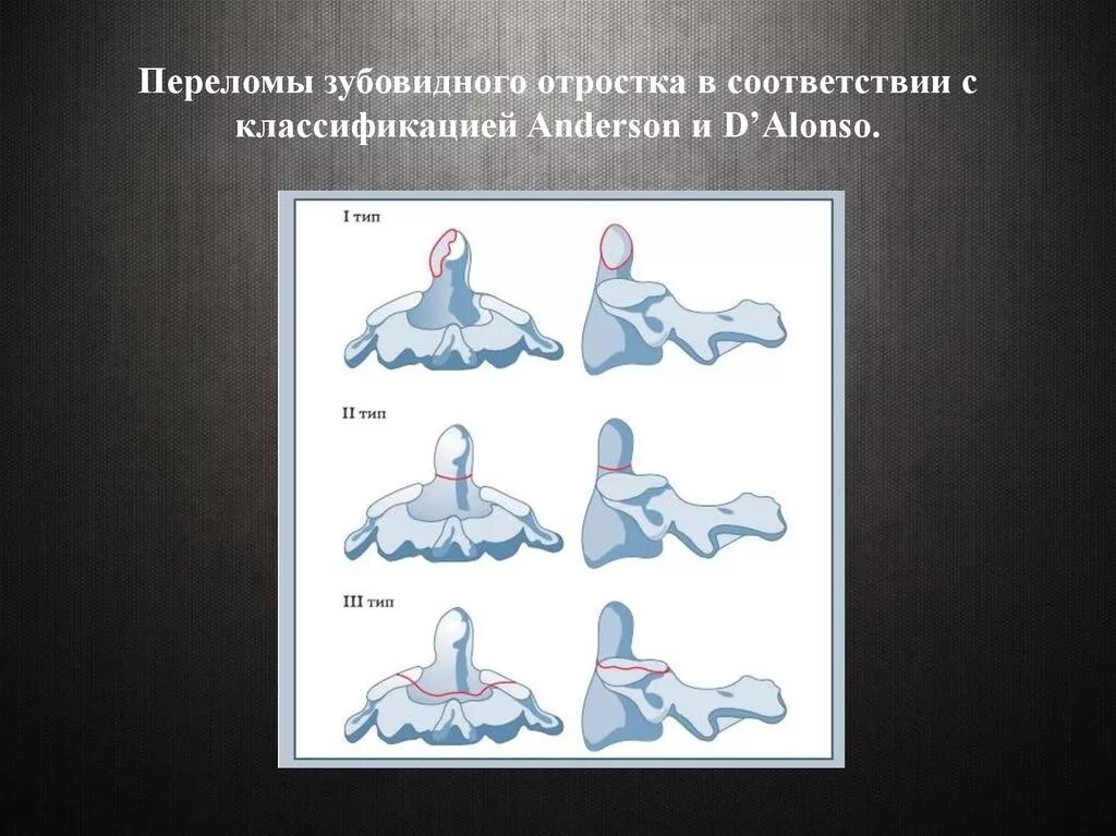 Классификация андерсена. Переломы зубовидного отростка классификация. переломы позвонков классификация. перелом с2 позвонка классификация. перелом зубовидного отростка.
