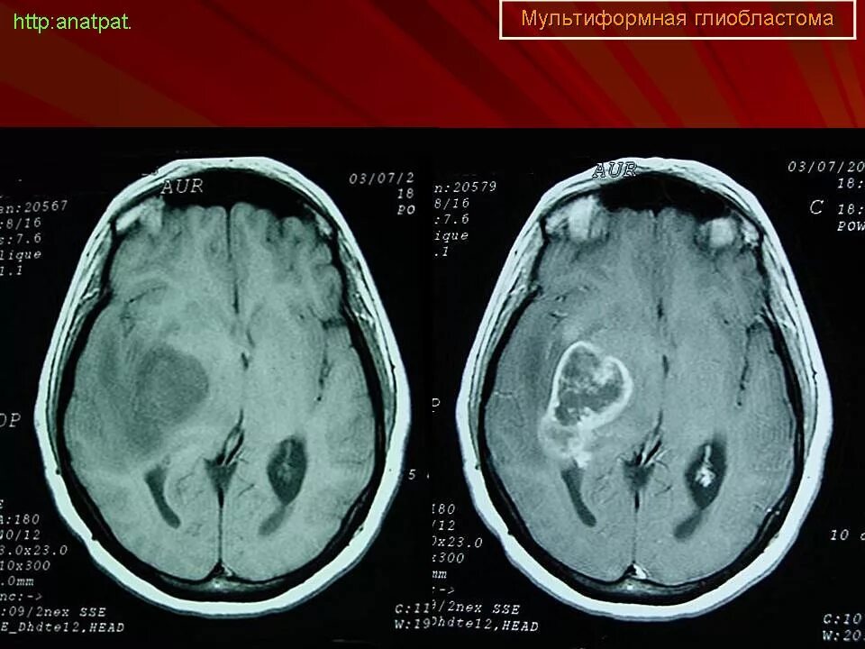 Глиобластома сколько живут. Мультиформная глиобластома мрт. Мультиформная глиобластома гистология. Глиобластома головного мозга гистология. Мультиформная глиобластома на мосту.