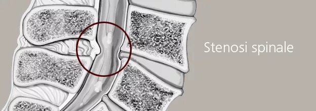 Поясничный абсолютный стеноз. Стеноз позвоночного канала л3 л5. Стеноз спинномозгового канала. Латеральный стеноз поясничного отдела. Относительный стеноз спинномозгового канала.