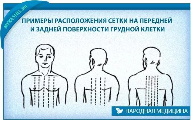 Можно делать йодовую сетку ребенку. Йодовую сетку на грудную клетку. едовая сетка при кашле. йодовая сетка при кашле ребенку. йодовая сетка на спине при кашле.