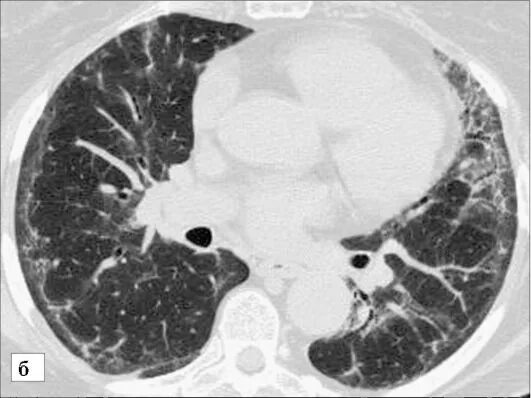 Интерстициальная пневмония на кт. Пневмофиброз на кт. Посттуберкулезный пневмофиброз на кт. Постпневмонический фиброз на кт. Застойные изменения в легких