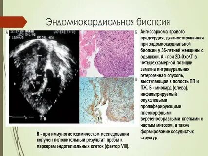 Фиброз это простыми словами