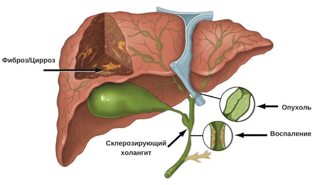 Фиброз желчных протоков. Первичный склерозирующий холангит--ПСХ. Склерозирующий желчный пузырь. Холангит желчевыводящих путей.