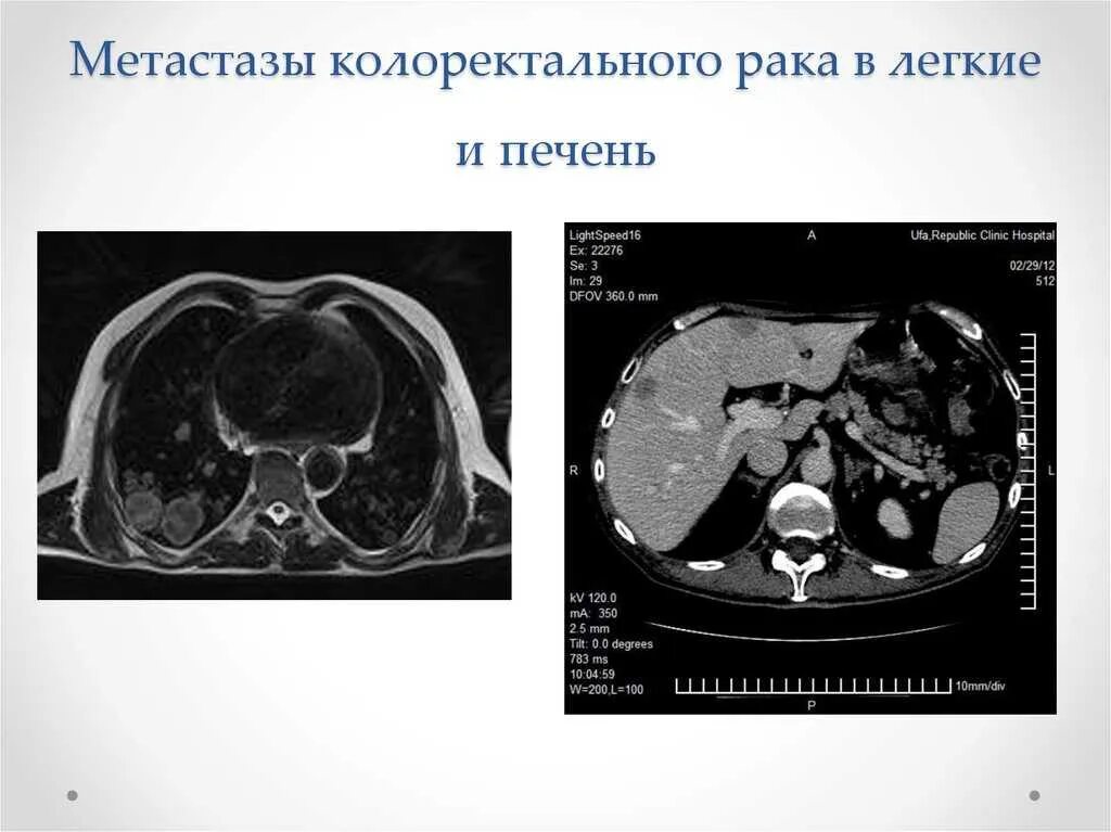 Метастазы в печени и легких прогнозы. Кт при метастазах в легких. гематогенные метастазы на кт.