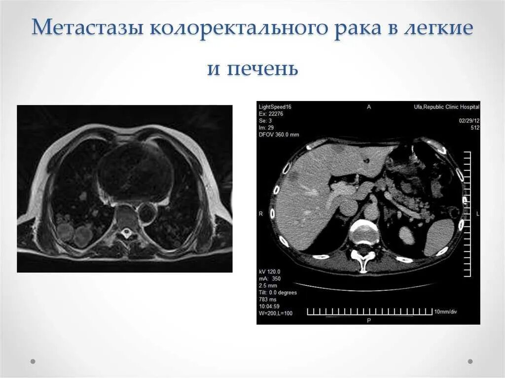 Продолжительность жизни при метастазах. Метастатическая карцинома печени кт. Метастазы колоректального. Кт при метастазах в легких.