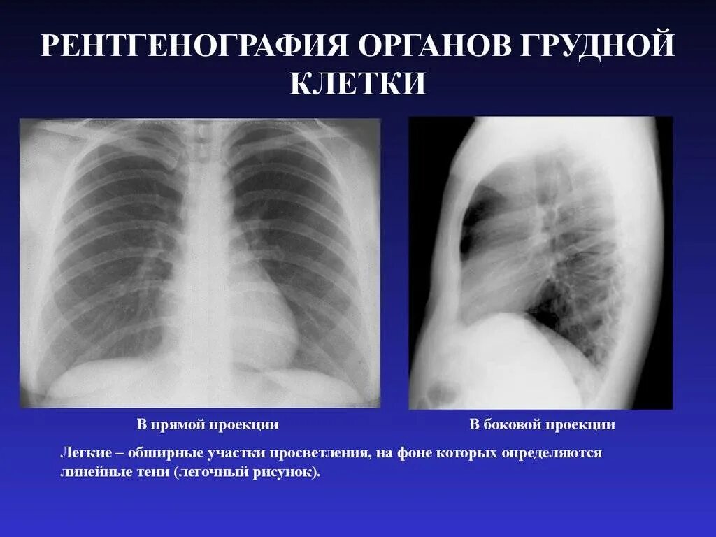 После рентгена можно делать флюорографию. Рентген легкого норма. Гемоторакс рентген. Рентген лёгких в 2 проекциях. Флюорография.