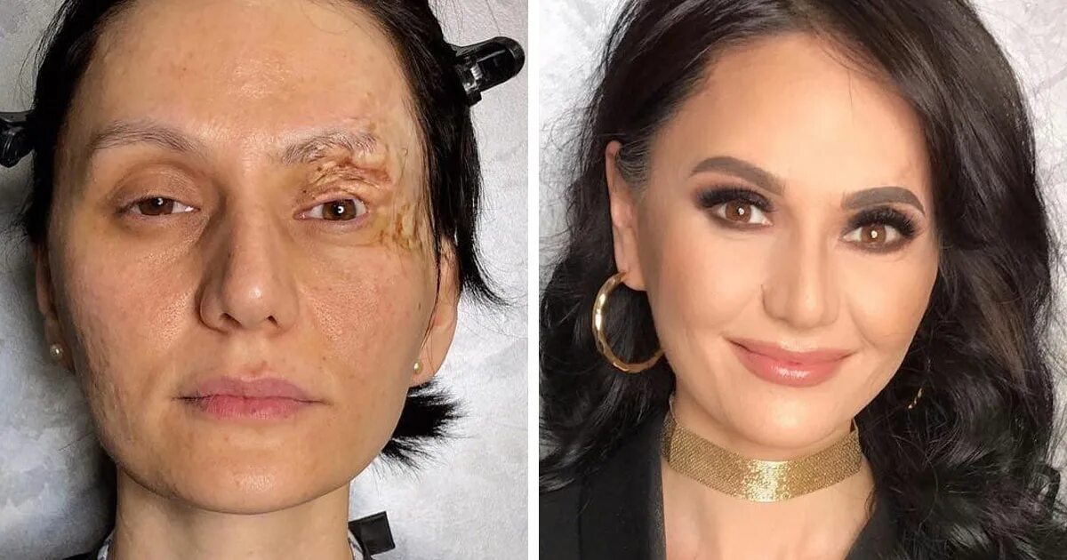 Мезотерапия для лица до и после. Танатопрактик-реставратор. Гоар аветисян преображения. Танатокосметика новосибирск. Танатопрактик-реставратор.