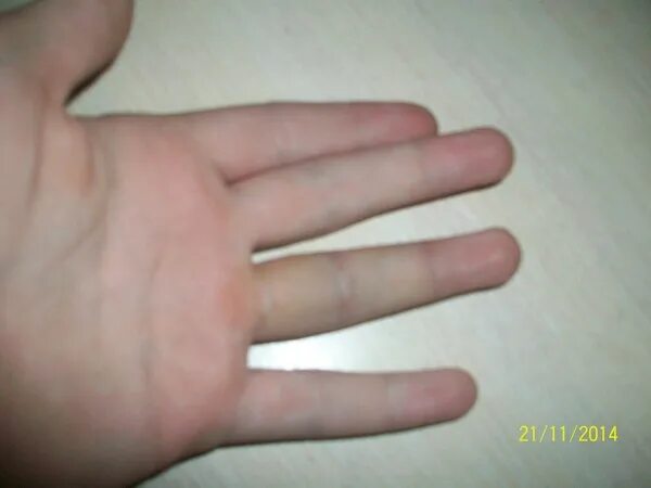 как определить перелом большого пальца