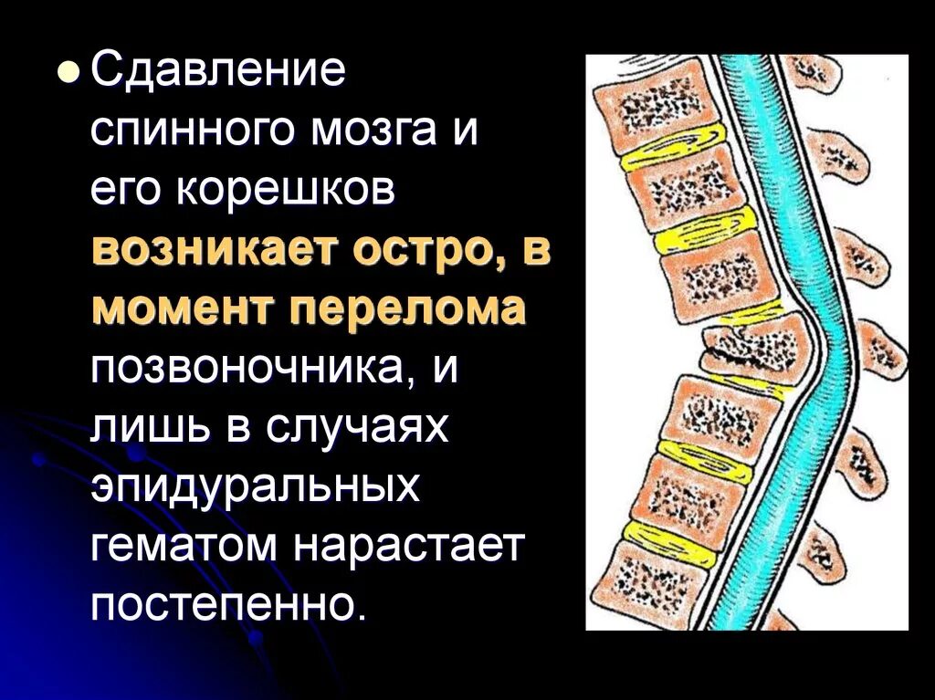 Сотрясение спинного. Сдавливание Корешков спинного мозга. Сдавление Корешков спинного мозга симптомы. Повреждение грудного отдела спинного мозга. Компрессия Корешков спинного мозга.