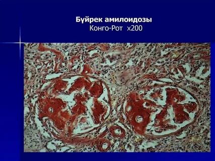 Амилоидоз прогноз
