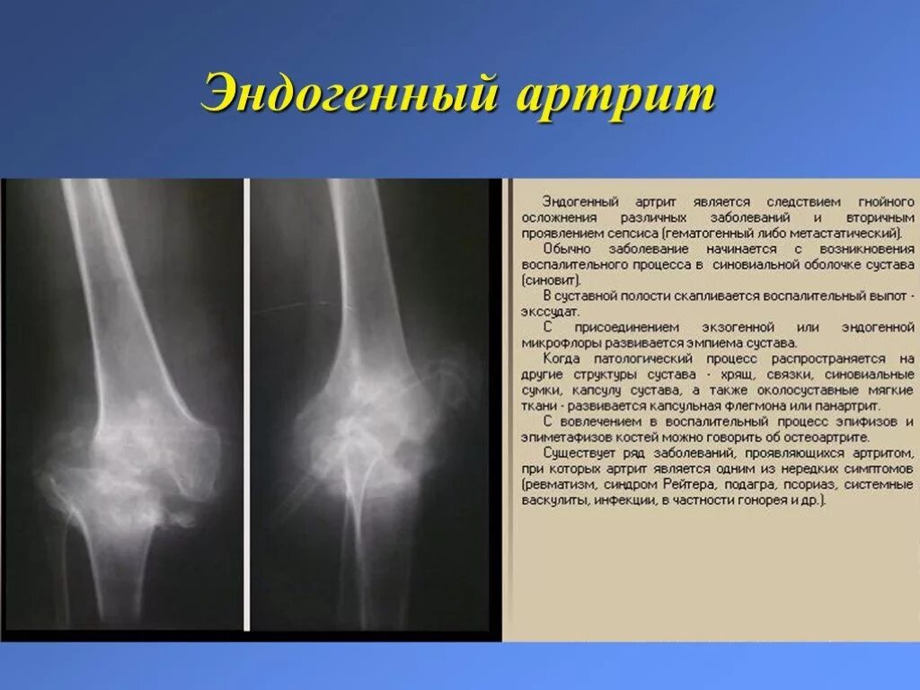 Гнойные заболевания суставов. Артрит кости остеомиелит. Гнойные заболевания костей и суставов. Воспалительные процессы в костях. Гнойно воспалительные заболевания костей.