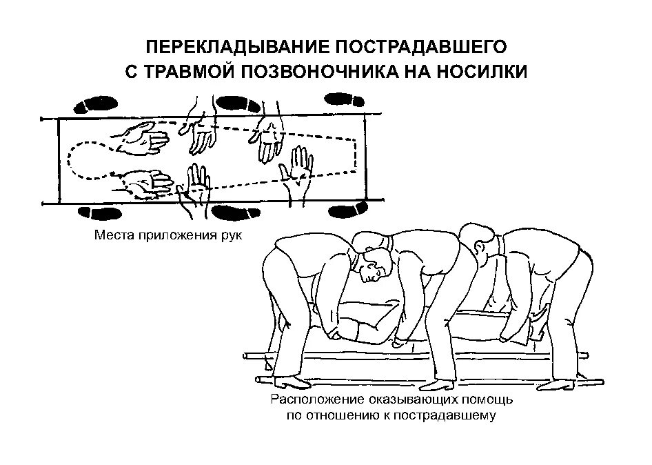 Повреждение позвоночника необходимо. Перекладывание пострадавшего с травмой позвоночника на носилки. ПМП при травме позвоночника. Положение пациента с переломом позвоночника при транспортировке:. Транспортировка пострадавшего при повреждении позвоночника.