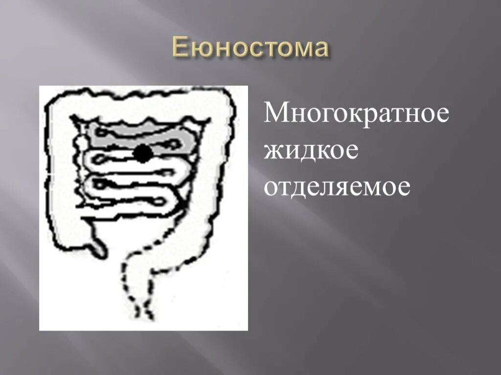 Еюностома это. Еюностома техника операции.