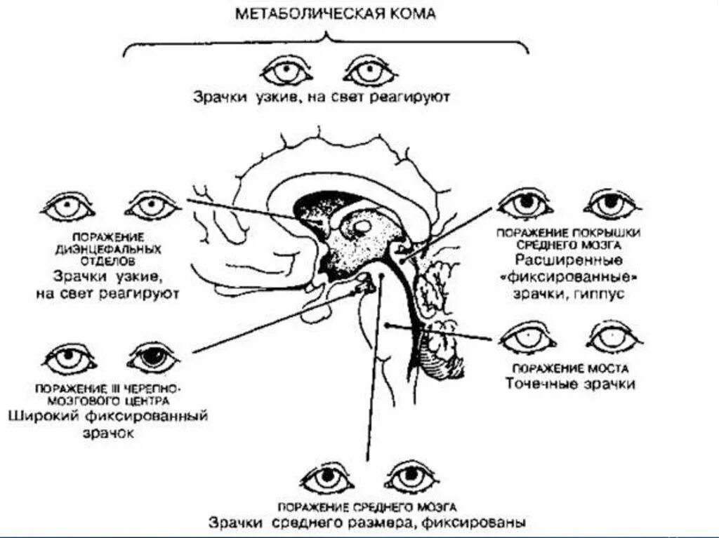 Зрачковый рефлекс при коме. Анизокория возникает при поражении какого отдела мозга. Зрачковые реакции в норме офтальмология. Зрачки не реагируют на свет при коме.