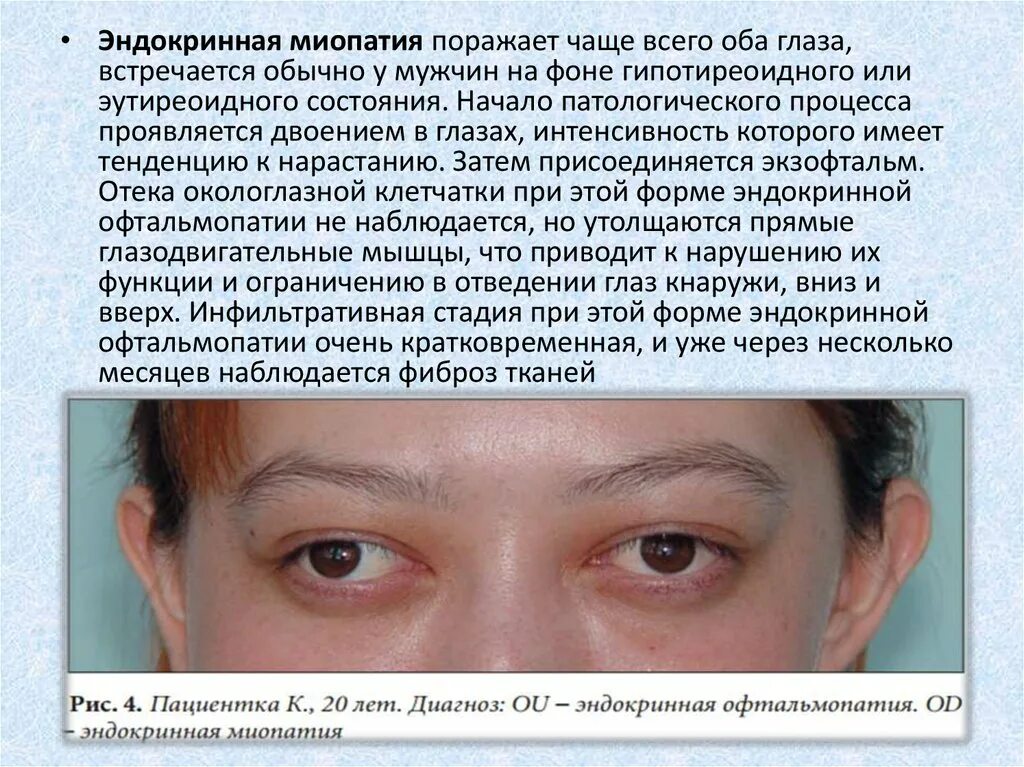 Миопатия глаза что это. Эндокринная миопатия глаз. Эндокриноофтальмопатия. Симптомы офтальмопатии.