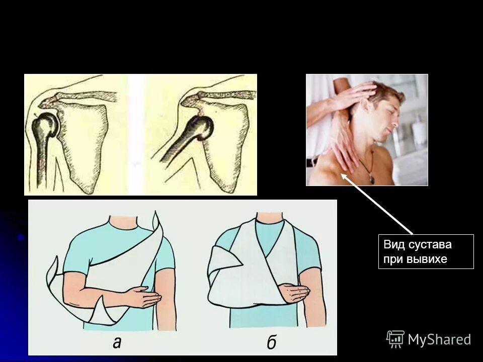Помощь при вывихе. Алгоритм действий по оказанию первой медицинской помощи при вывихах. Помощь при вывихе суставов. Алгоритм оказания пмп при вывихе. При оказании первой помощи при вывихе сустава необходимо.