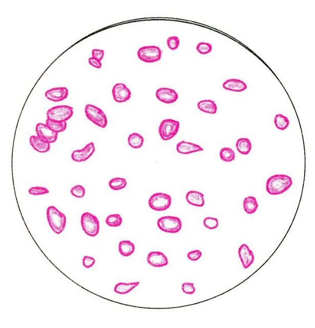 Пойкилоцитоз анемия. Анизоцитоз пойкилоцитоз гипохромия. Анизоцитоз микроцитоз. Полихромазия анизоцитоз пойкилоцитоз анемия. Эритроциты мазок гипохромия.