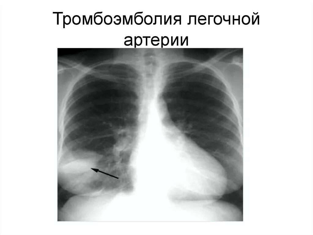 Тромболия легочной артерии. Тэла пневмония рентген. Тромбоэмболия легочной артерии рентген. Тромбоэмболия на рентгене легких.