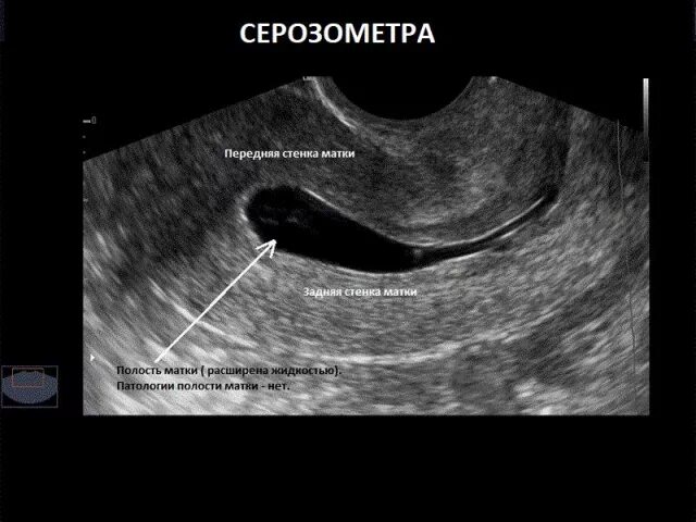 Эндометрий 7 5. Полип эндометрия в матке на УЗИ. Серозометра эндометрия.