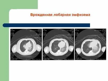 Врожденная долевая эмфизема