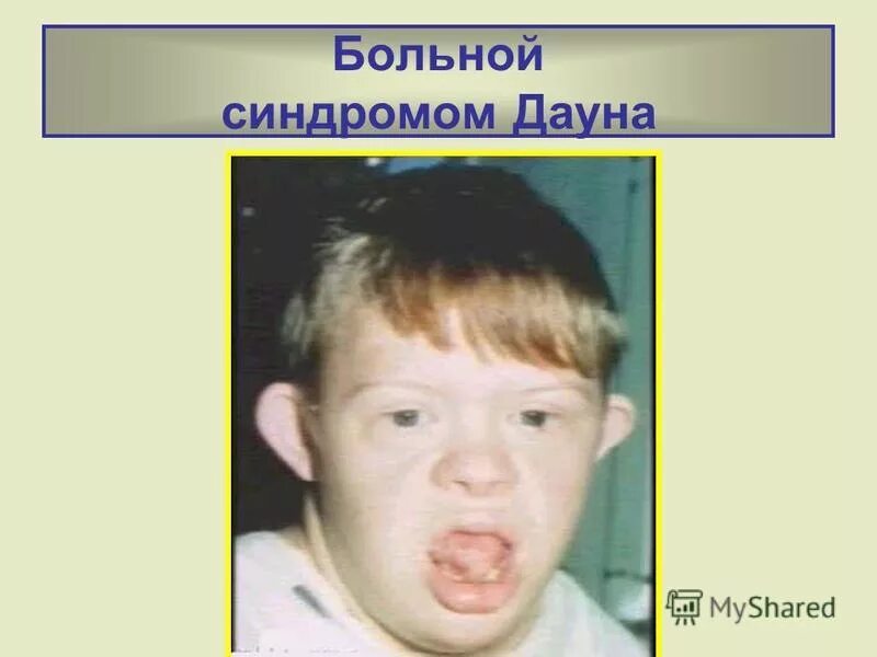 Синдром дауна характеристика. Страдает синдромом дауна. Болезнь дауна трисомия 21. Дети с синдромом дауна. Страдает синдромом дауна.