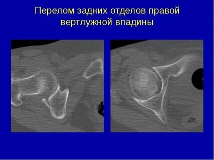 Перелом впадины