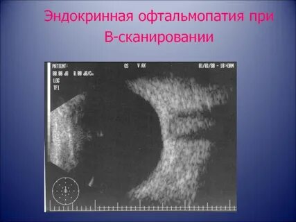 Узи зрительного нерва