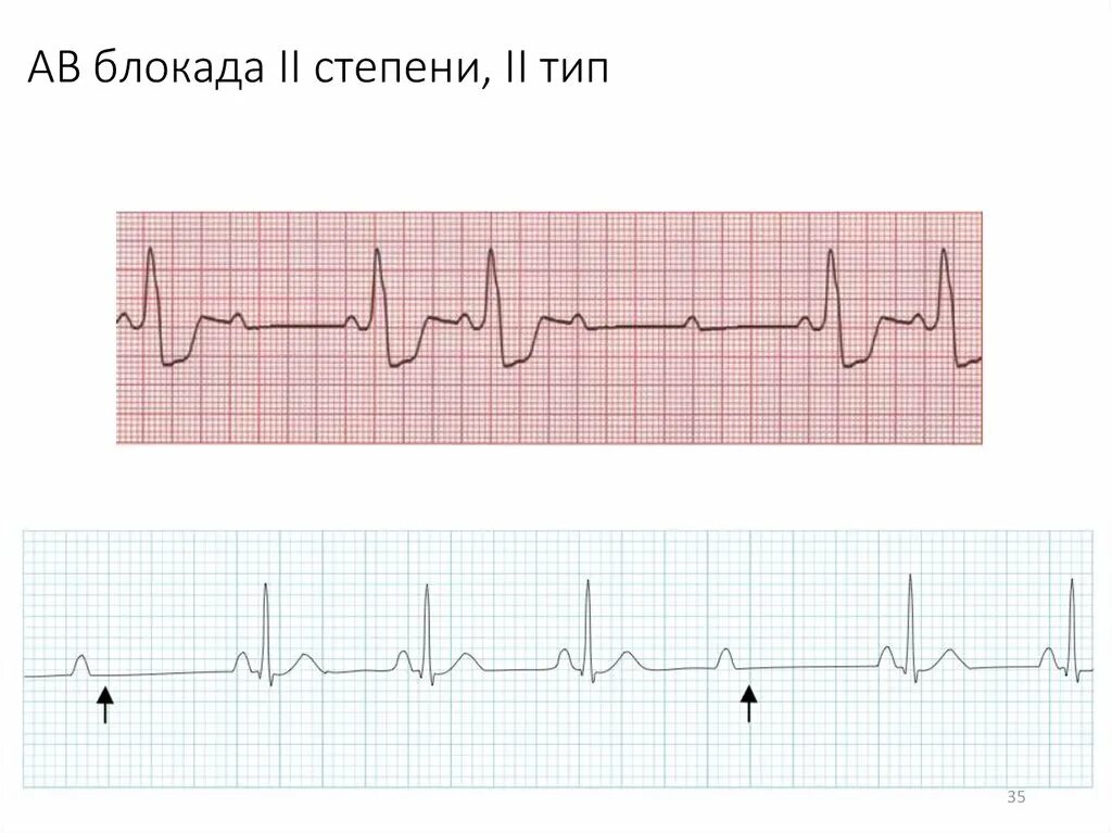 Блокады 2 степени армия. Брадиаритмия на ЭКГ. АВ-блокада 2 степени 2 типа у детей. АВ блокада 1 степени у спортсменов. Синусовая брадиаритмия на ЭКГ.