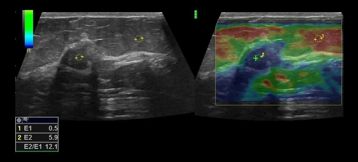 Эластография щитовидной железы что это. Эластография молочных желез шкала. Компрессионная эластография молочных желез. Ультразвуковая компрессионная эластография. Tsukuba эластография.