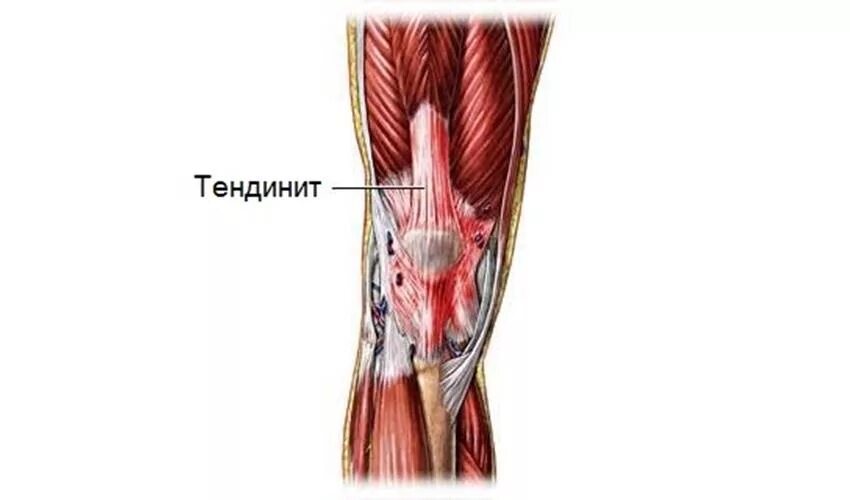 Боль коленной связки. Тендинит сухожилия четырехглавой мышцы. Тендинит четырехглавой мышцы бедра. Тендинит четырехглавой мышцы коленного сустава. Тендинит сухожилия квадрицепса.